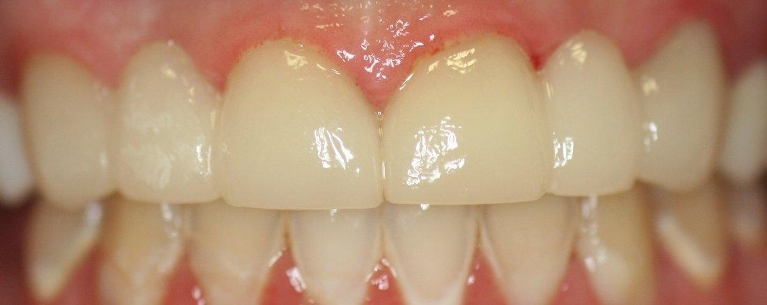 Smile-enhancement-with-Anterior-Bridge-After-Image
