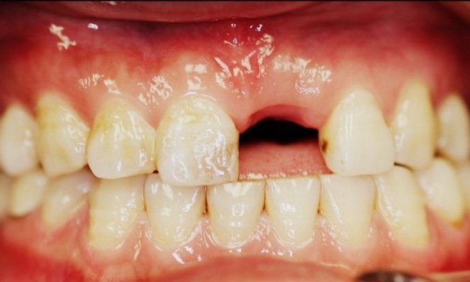 Implant-Before-Image