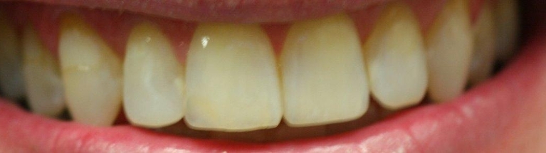 Teeth-Whitening-Before-Image
