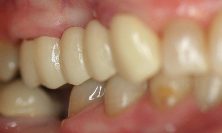 Dental-Bridge-After-Image