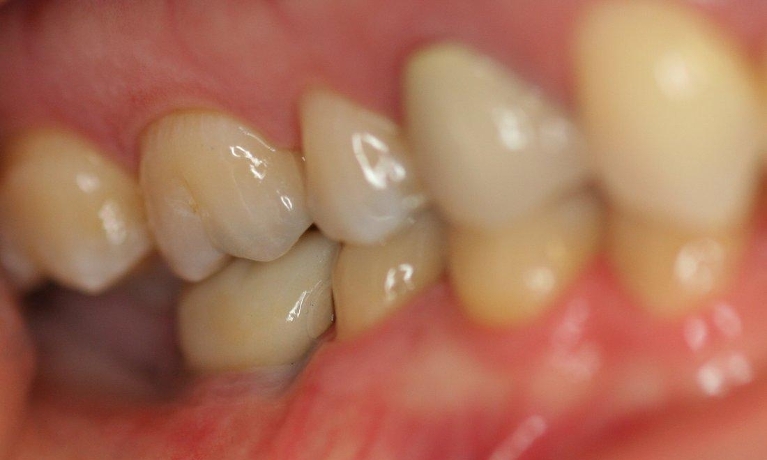 Dental-Implant-After-Image