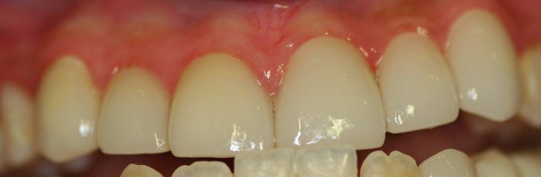 Porcelain-Crowns-After-Image