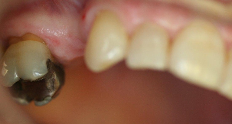 Dental-Bridge-Before-Image