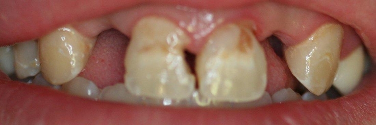 Smile-enhancement-with-Anterior-Bridge-Before-Image